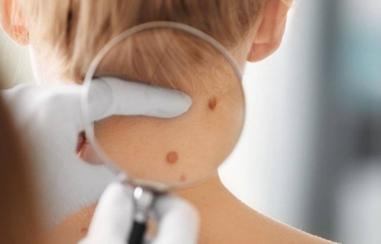 3 DẤU HIỆU LẠ XUẤT HIỆN TRÊN DA CẢNH BÁO TÌNH TRẠNG GAN ĐANG HOẠT ĐỘNG RẤT KÉM